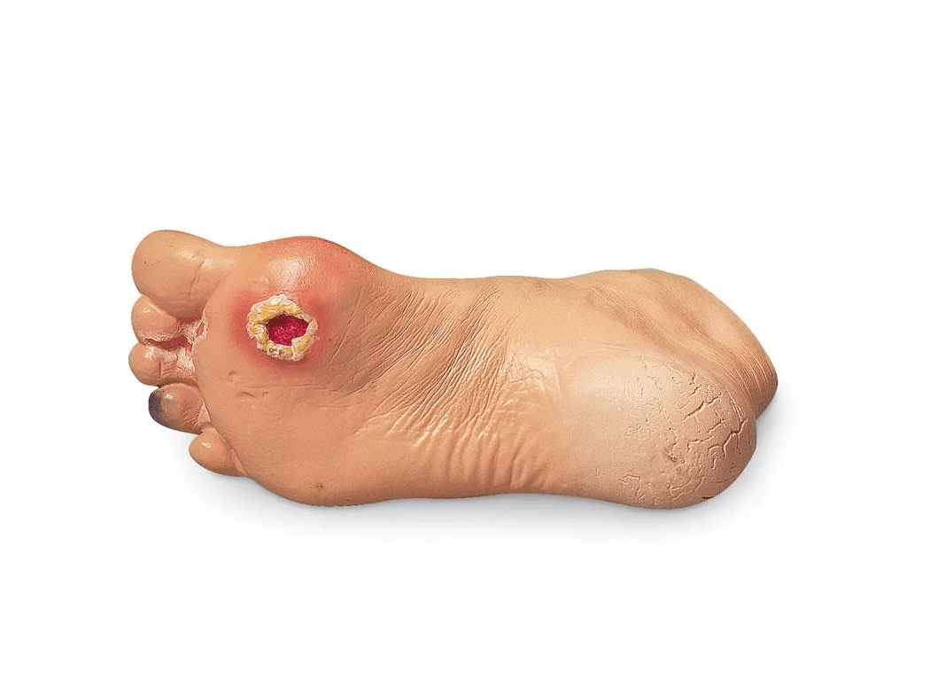 Erweiterte Fußprobleme - Erler - Zimmer